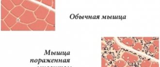 The teres major muscle of the shoulder. Functions, anatomy, how to treat if it hurts