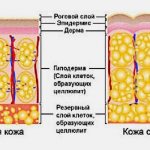 Что такое целлюлит