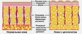 Что такое целлюлит