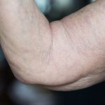 Дряблая кожа на руках