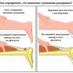 Как понять, что сухожилие разорвано