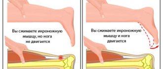 Как понять, что сухожилие разорвано