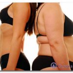 ожирение 3 степени