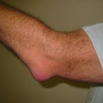 После тренировки мышцы опухли и болят что делать