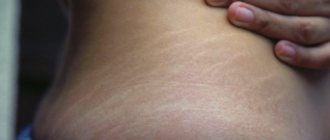 растяжки на боку