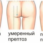 схема градации птоза