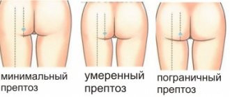 ptosis gradation scheme