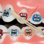 Способы крепления резинок для брекетов