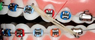 Способы крепления резинок для брекетов