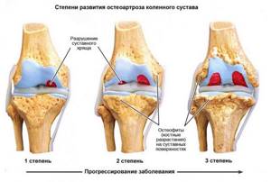 Стадии развития остеоартроза