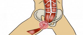 hip adductor tendinopathy