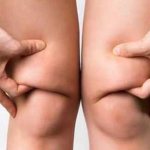 Жировые отложения в коленях находятся в том числе между мышцами и костями, поэтому могут относиться к висцеральному (внутреннему) типу жира.
